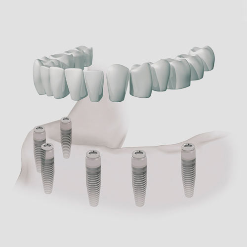 Implantes dentales en Lliçà d'Amunt