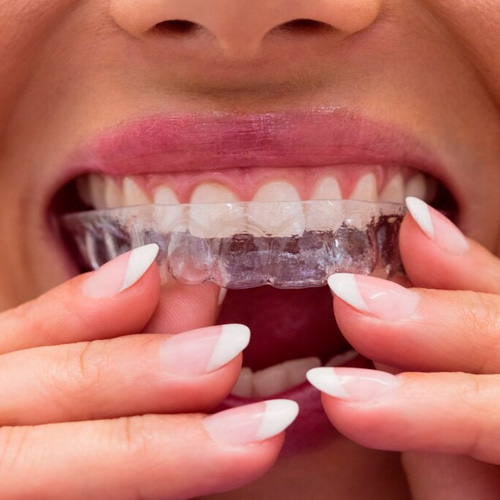 Ortodoncia invisalign Dr Ramon Garcia