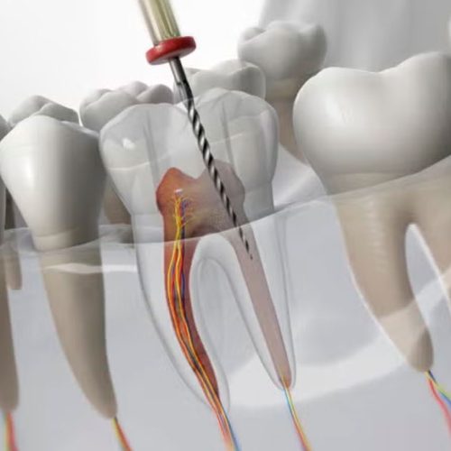 endodoncia en Lliçà d'Amunt