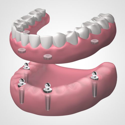 Implantes dentales en Lliçà d'Amunt